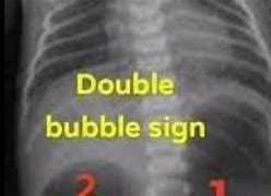 Double Bubble Sign Adalah